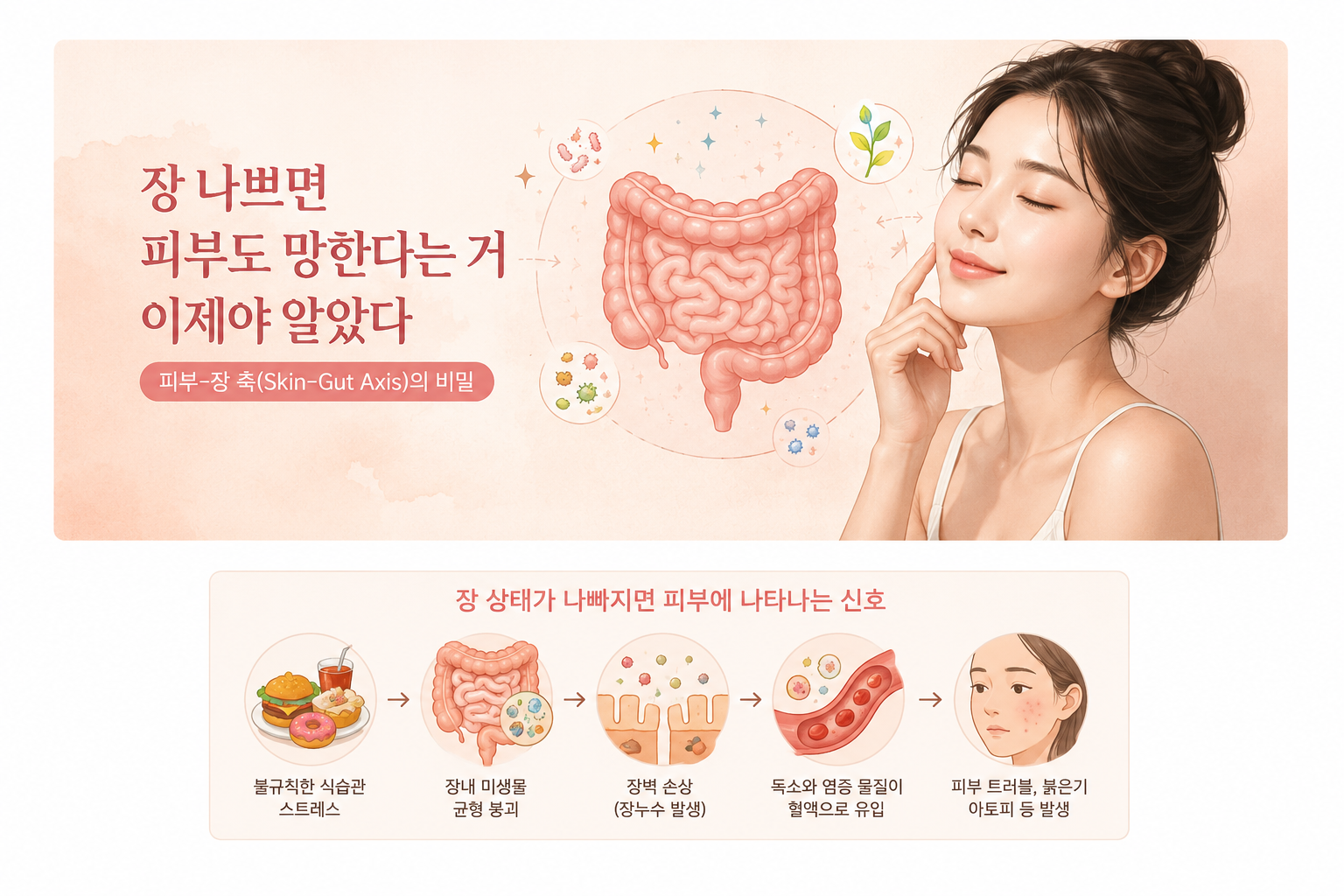 피부와 장의 연결 고리(Skin-Gut Axis)를 나타내는 일러스트. 장내 미생물 불균형이 혈관을 통해 피부 염증을 유발하는 과정을 보여주는 이미지