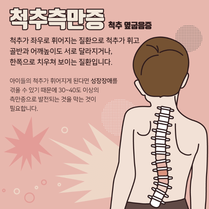 척추측만증 증상