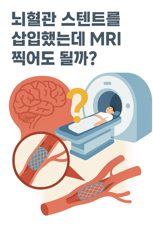 뇌혈관 스텐트를 삽입했는데 MRI 찍어도 될까?