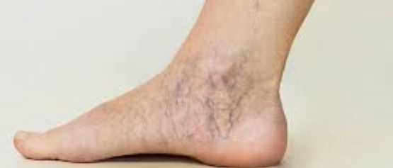 하지정맥류란?