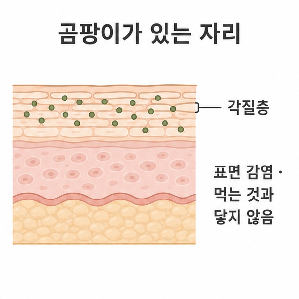 피부 단면 도해, 각질층에 자리 잡은 곰팡이가 표면 감염이라는 점을 보여 주는 그림