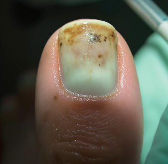 발톱이 검게 변하는 이유 7가지와 해결 방법