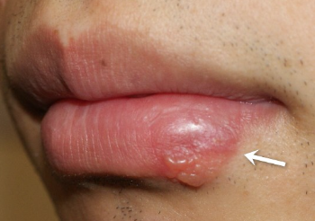 헤르페스성 구내염