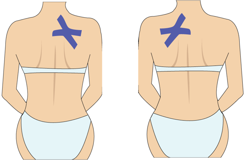 견갑골 내측 통증