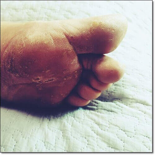 당뇨발 초기 증상 원인 및 예방과 치료 관리