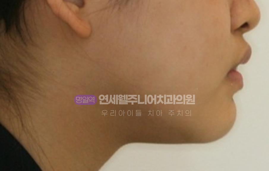 청소년 앞니 돌출과 입술의 전후방 관계를 살펴보는 측면 안모 사진