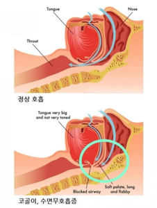 코골이 수술