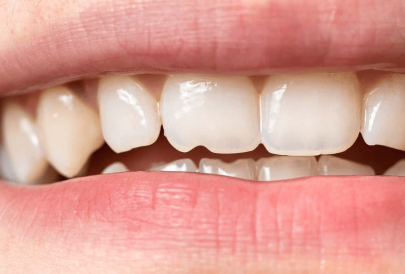 앞니 레진 비용