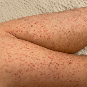 자반증 - 허벅지 다리