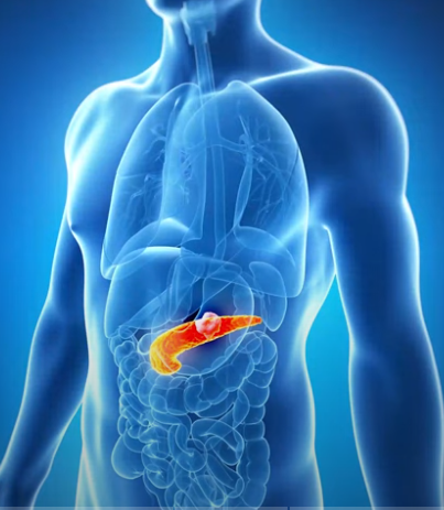 췌장암