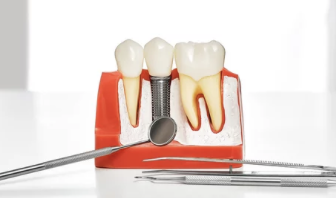 임플란트 모형 사진