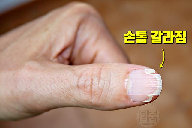 콜라겐 결핍증 부족증상 손톱 갈라짐 탈모