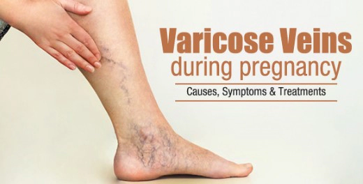 하지정맥류 초기증상