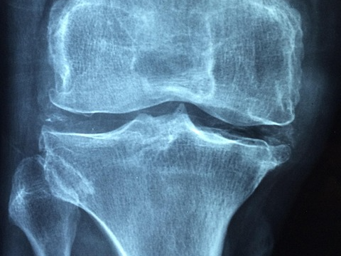 퇴행성관절염 증상 치료법