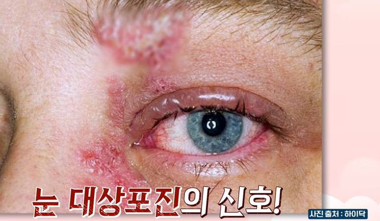 대상포진 초기 증상