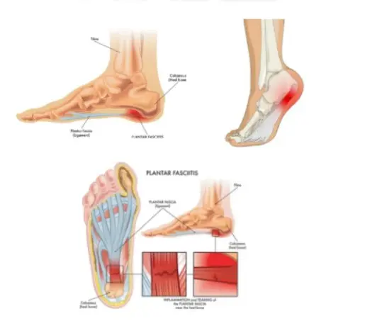 족저근막염 원인
