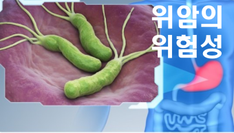 위암의-위험성-관련-사진