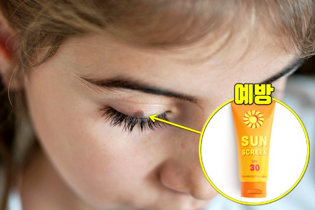 눈꺼풀 선크림 썬크림 추천,눈시림 없는 선크림,피부암,흑색종 증상,건강,팁줌 매일꿀정보