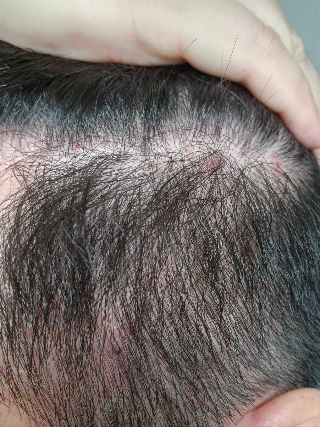 지루성 두피염으로 인한 피부가 붉으색으로 나타난 모습