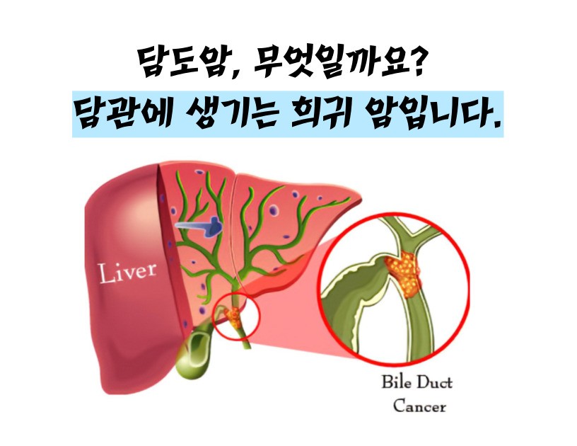 담도암 이란 / 담도암 증상