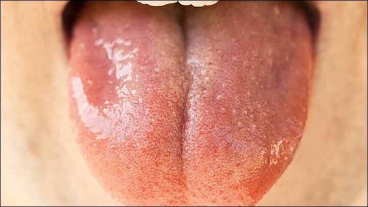 혓바늘이 돋는 이유 비타민