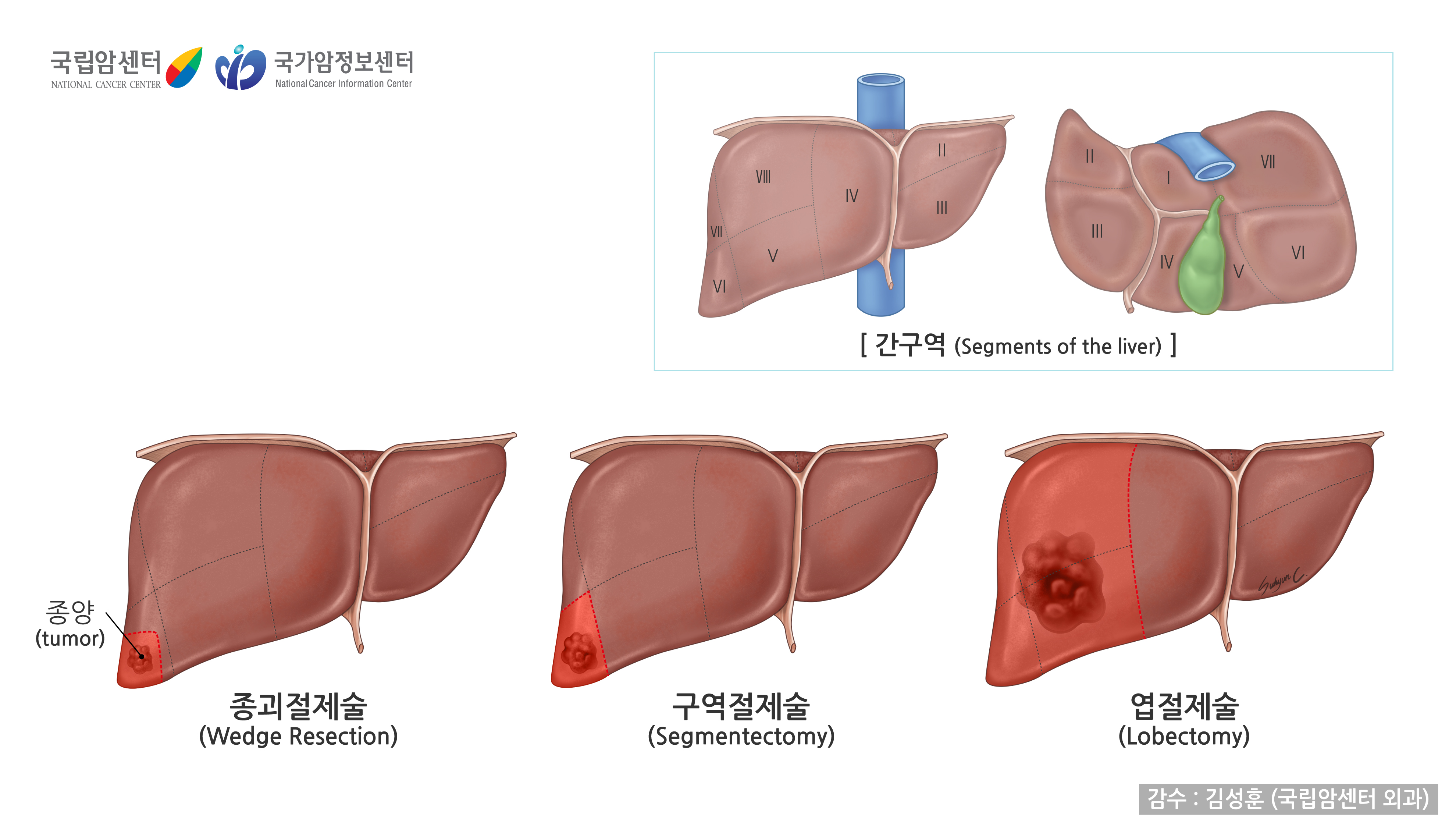 간암치료, 다학제진료, 경동맥화학색전술, 고주파열치료술, 면역항암제