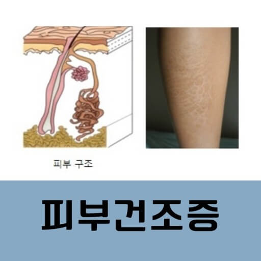 피부건조증