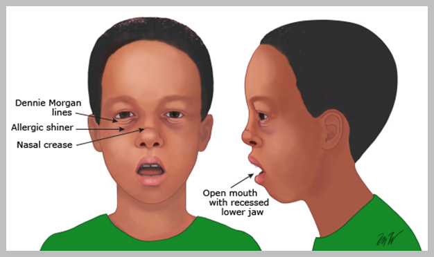 아데노이드형 얼굴