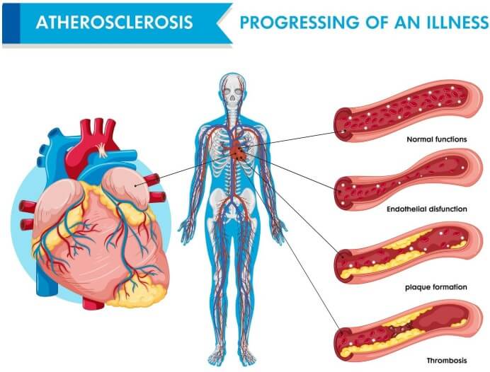 혈관 속 노폐물