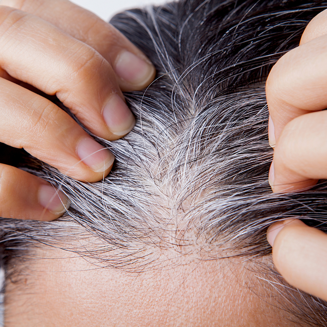 흰머리 나는 이유와 관리 방법, 효과적인 해결책