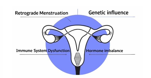 자궁내막증 원인과 의심증상