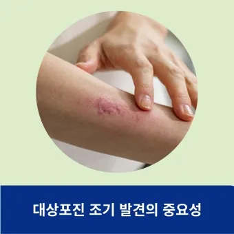 대상포진 치료방법에 대한 총정리 건강 질병관리_20