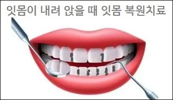 잇몸이 내려 앉을 때 잇몸 복원치료
