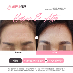 미간필러