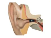 보청기-종류-가격-보조금-귀걸이형-귓속형-삽입형