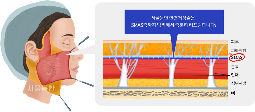 안면거상리프팅