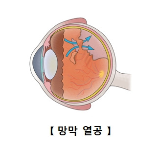 망막박리 증상, 원인, 치료 방법