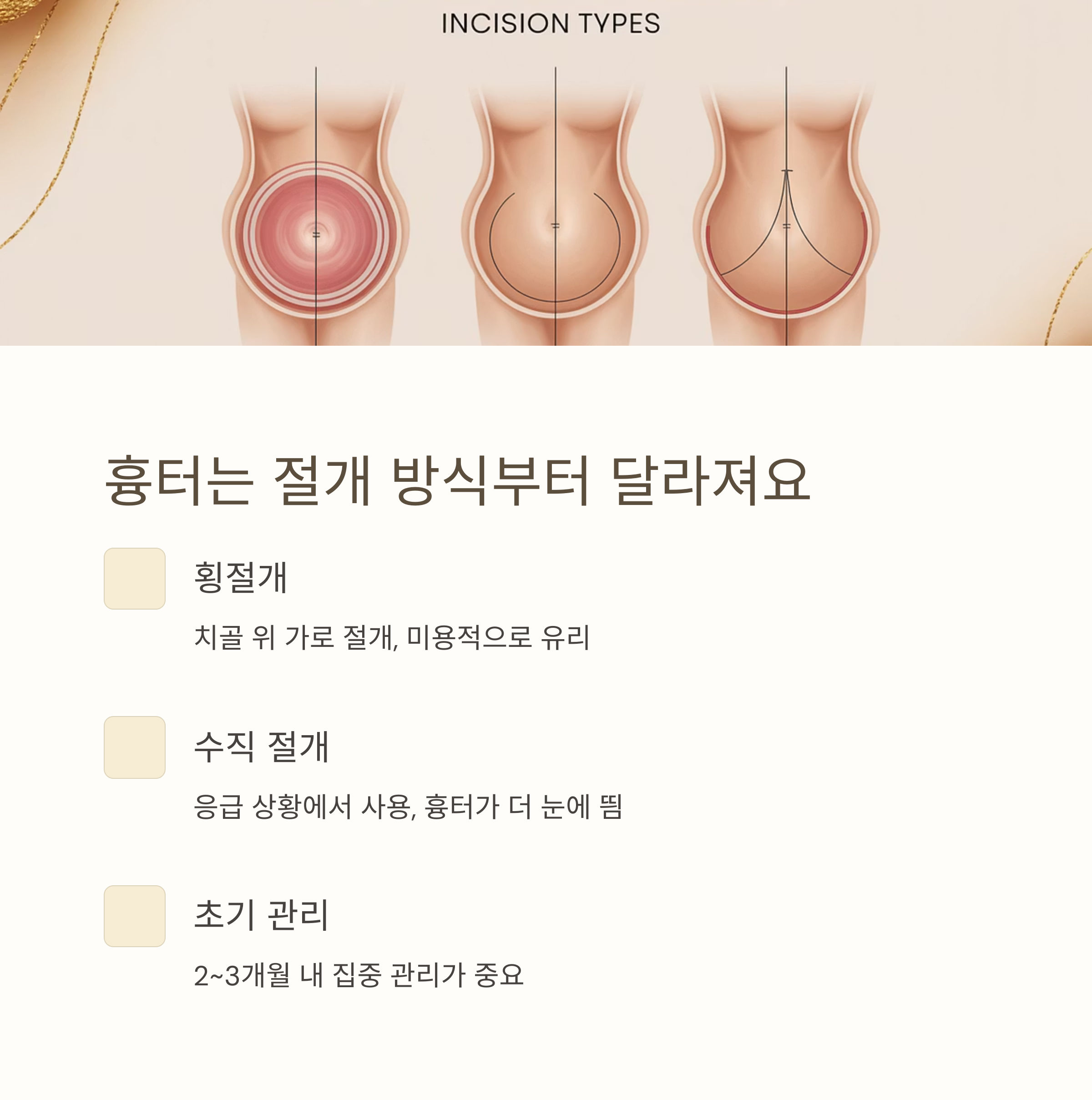 제왕절개 절개 방식별 흉터 위치를 비교한 일러스트 이미지 (횡절개, 수직절개 등)