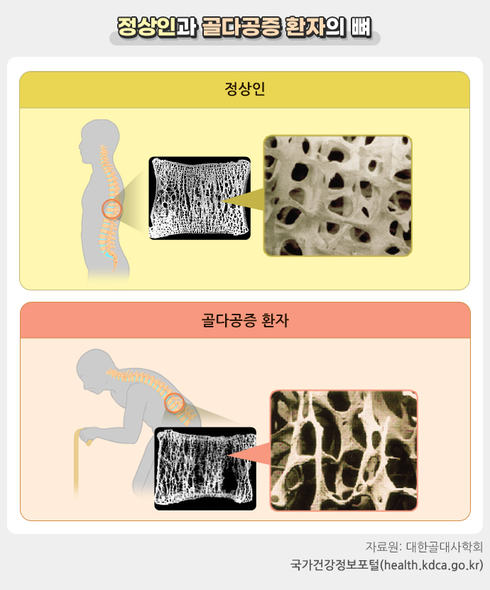 골다공증 증세,