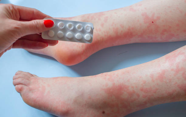 즉각성 두드러기와 보습 성분: 면역 경로와 안전한 관리법