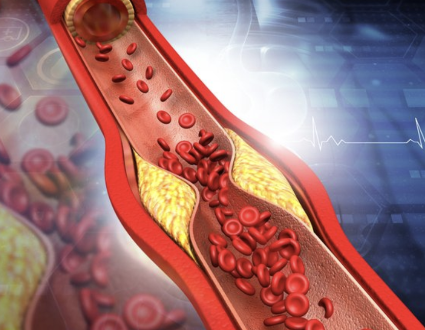 중성지방 낮추는 방법 13가지 총정리 섬네일