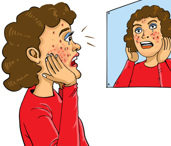 여드름 흉터 발생 원인과 종류 관련 사진