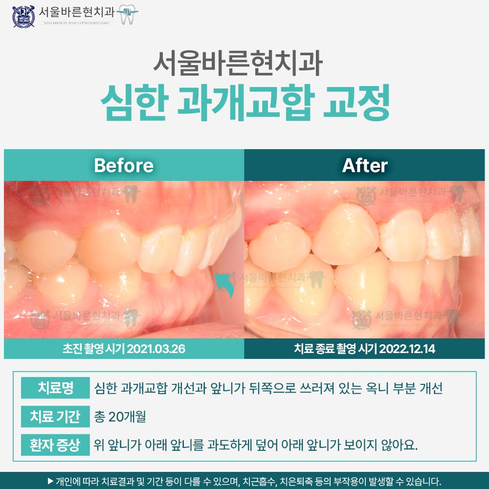 부산치아교정