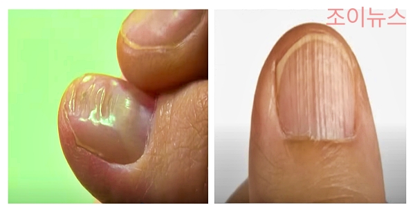 손톱 모양과 표면의 변화가 있는 경우