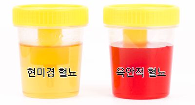 소변에 피가 섞여서 나오는 증상 혈뇨증상