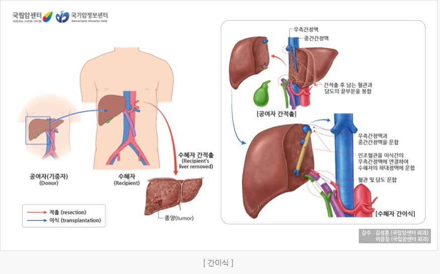 간암 치료 간이식