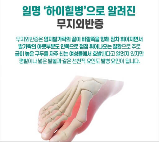 무지외반증과 하이힐