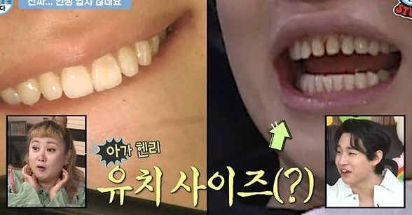 덧니-라미네이트-가격