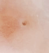 티눈 없애는 방법