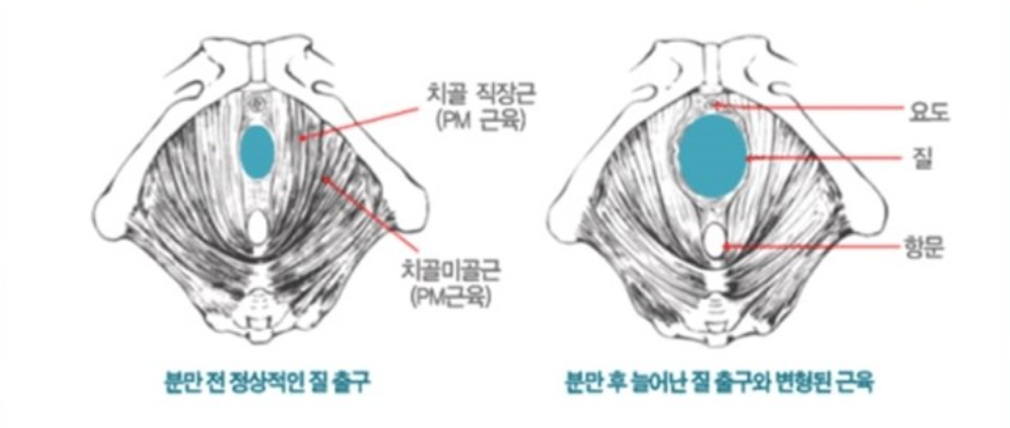 질이완증 / 질 이완 증상, 노화일까? / 질이완증 체크리스트 / 방치하면 생기는 문제와 해결 방법